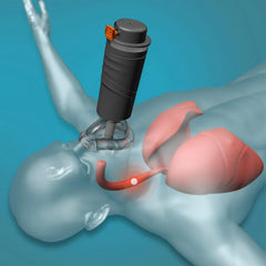 Portable Automatic Choking Rescue Device
